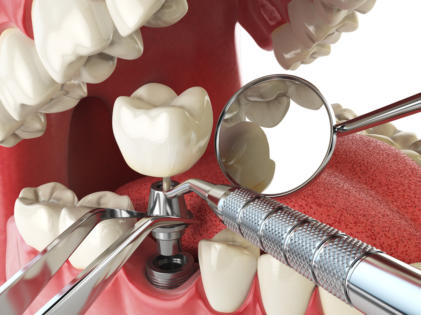 Tooth human implant. Dental implantation concept. Human teeth or